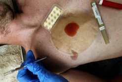 H&H Medical Tension Pneumothorax Access Kit (TPAK) With NeedleBy Safeguard Medical -Medical Supply Store TPAK p04 1200Wx1200H 8845804601374